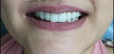 After orthodontic treatment
